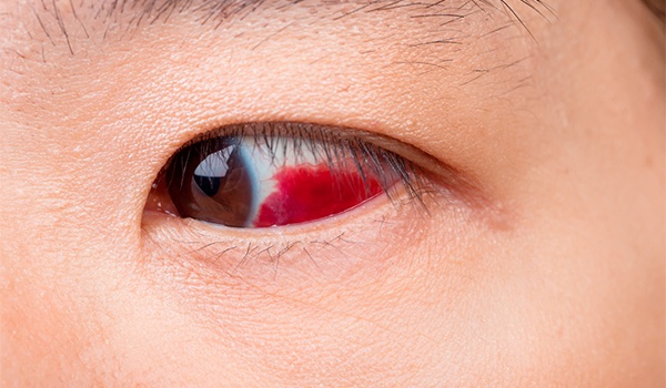 Atención clínica y quirúrgica de desgarro de retina
