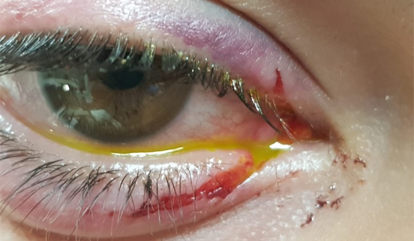 Atención clínica y quirúrgica de traumas oculares