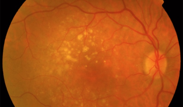 Diagnóstico y tratamiento de degeneración macular