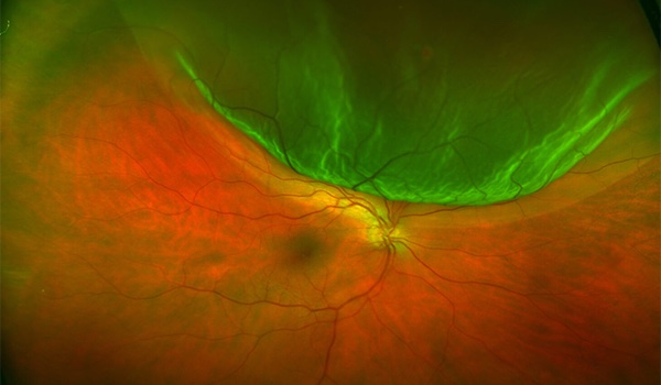 Diagnóstico y tratamiento de desprendimiento de retina