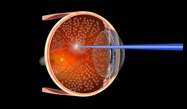 Fotocoagulación con láser retiniano en retinopatía diabética proliferativa