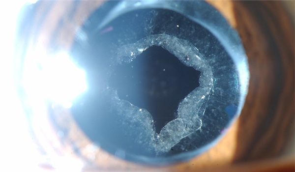 Fotodisrupción en segmento anterior (capsulotomía e iridotomías)