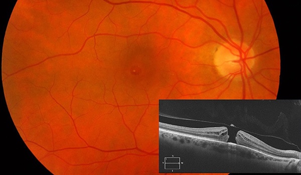 Manejo clínico de agujero macular