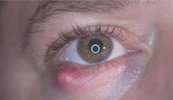 Manejo clínico de celulitis preseptal y postseptal