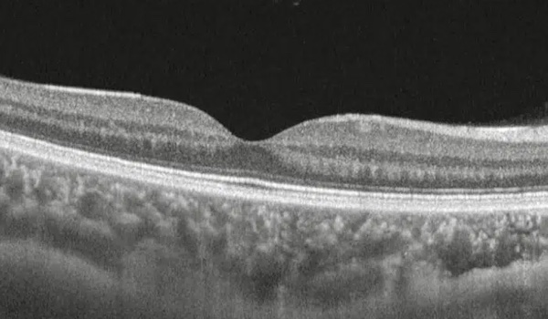 Tratamiento multimodal de membrana epirretiniana