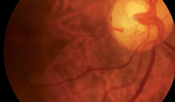 Tratamiento multimodal de retinopatía diabética